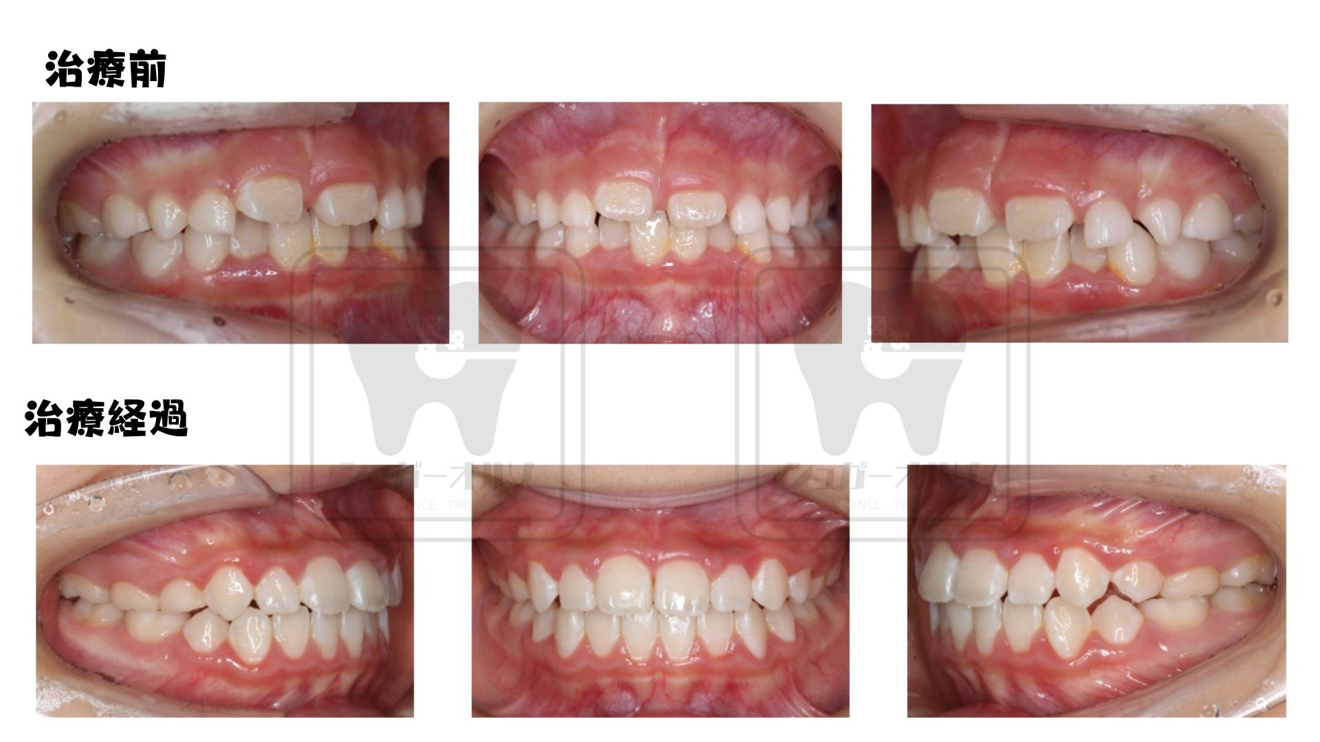 小児矯正 叢生、過蓋咬合症例