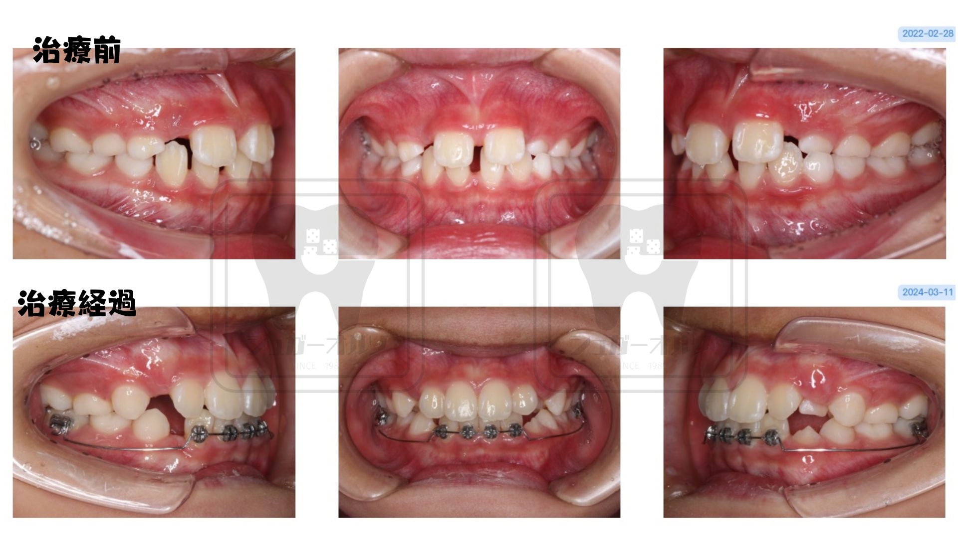 小児矯正 叢生、過蓋咬合症例
